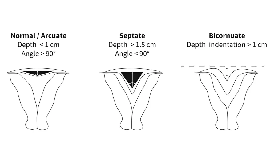 Difference Between Bicornuate and Septate Uterus