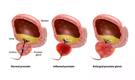 Difference Between BPH and Prostatitis
