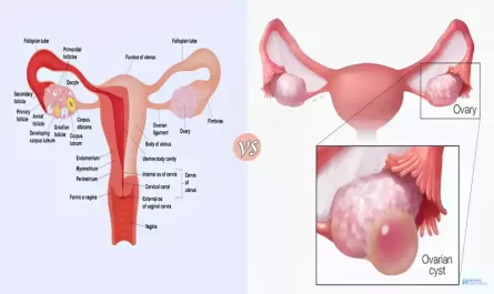 Difference Between Endometrioma and Hemorrhagic Cyst