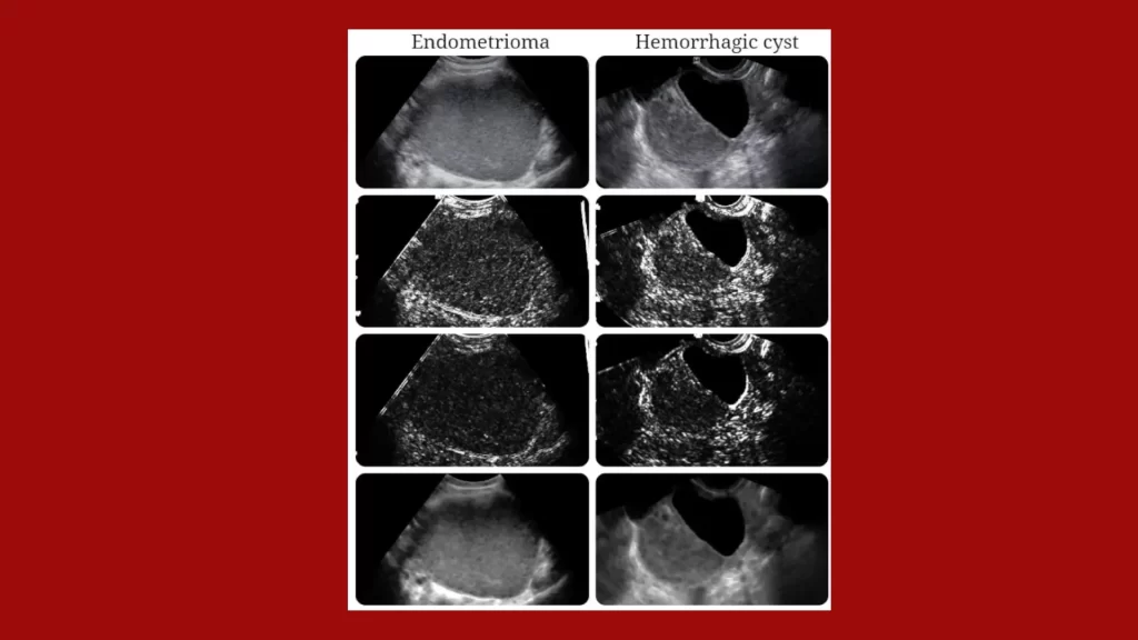 Endometrioma-hemorrhagic-syringomyelia