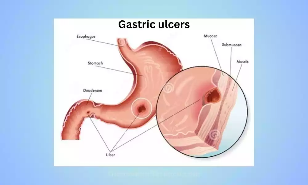 Gastric ulcers