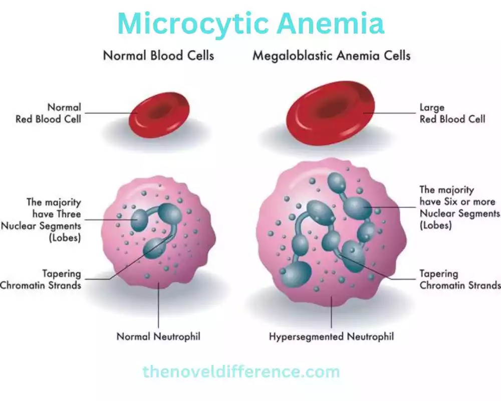 Microcytic Anemia