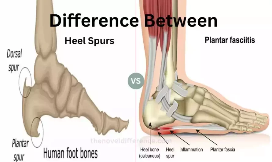 Difference Between Heel Spurs and Plantar Fasciitis