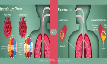 Interstitial Lung Disease and Bronchiectasis