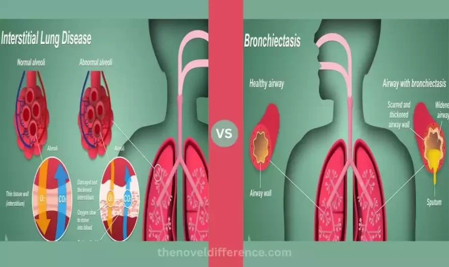Difference Between Interstitial Lung Disease and Bronchiectasis