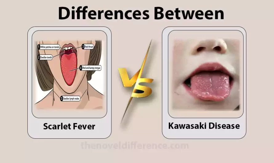 Difference Between Scarlet Fever and Kawasaki Disease