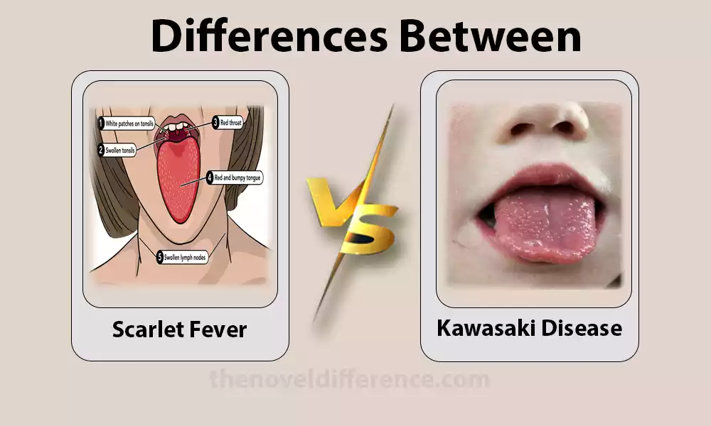 Scarlet Fever and Kawasaki Disease