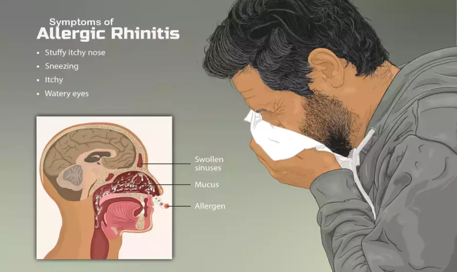 Difference Between Allergic Rhinitis and Vasomotor Rhinitis