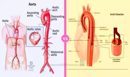 Aorta and Artery