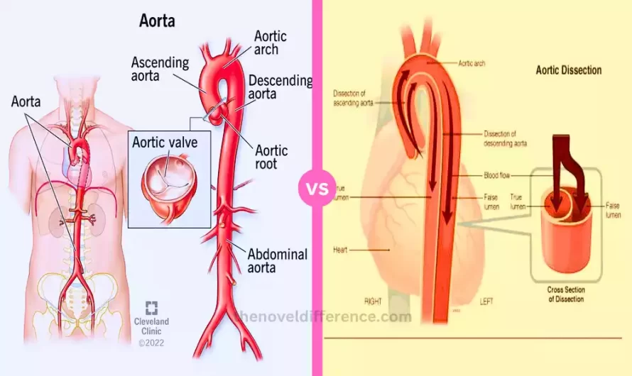 Difference Between Aorta and Artery