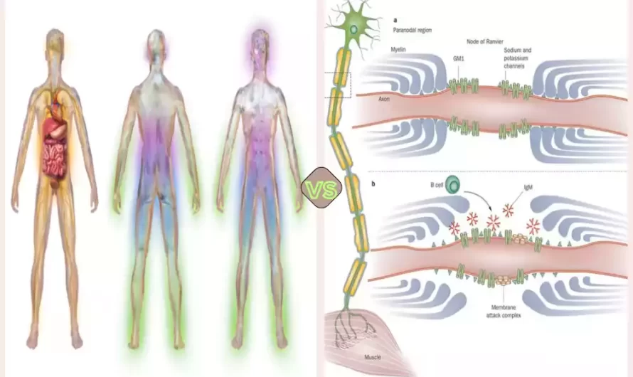 Difference Between Axonal and Demyelinating Neuropathy