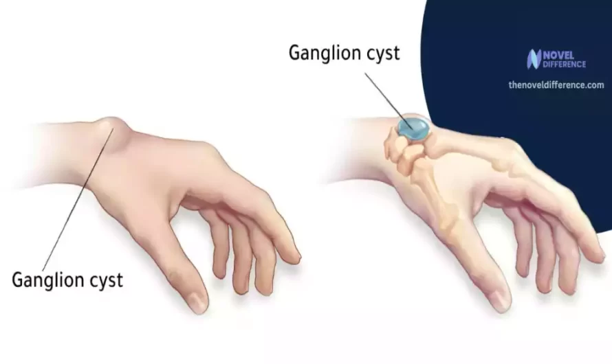 Difference Between Carpal Boss and Ganglion Cyst