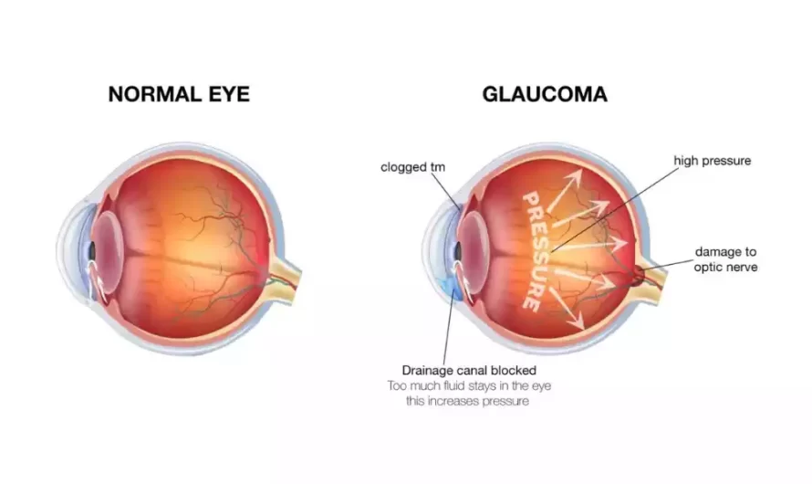 Between Glaucoma and Ocular Hypertension best 14 difference