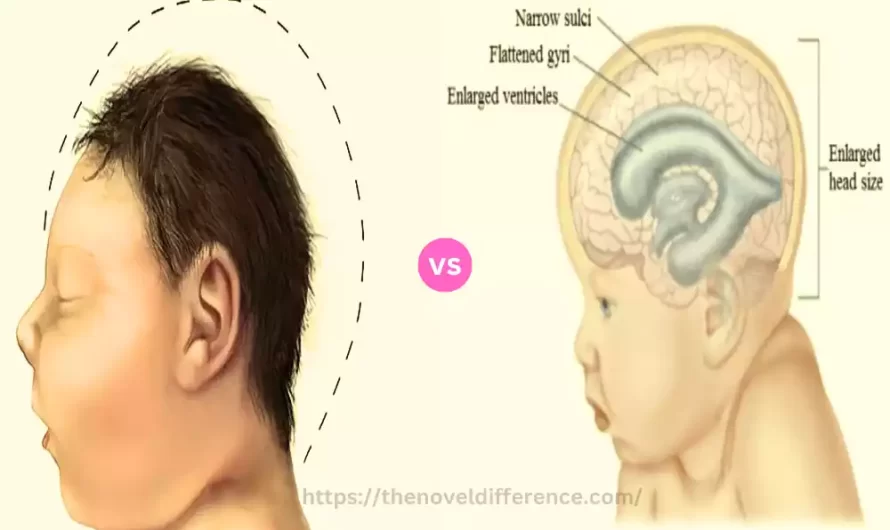 Difference Between Macrocephaly and Hydrocephalus