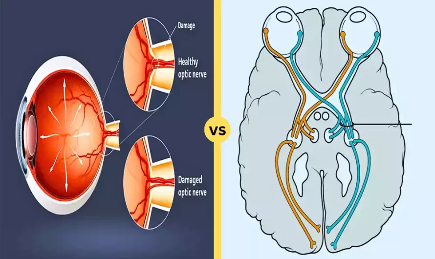 Difference Between Optic Nerve and Optic Tract