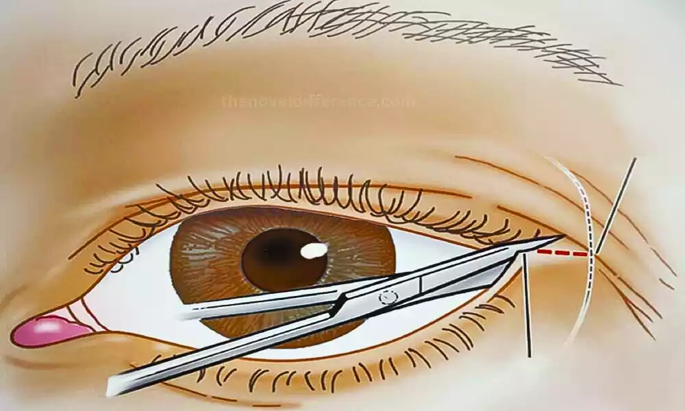Optic Nerve