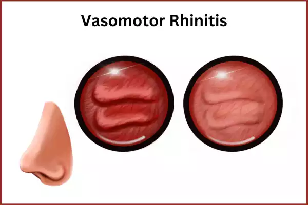 Vasomotor Rhinitis