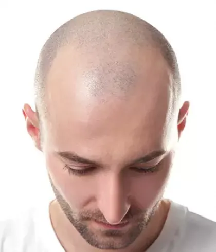 Alopecia Totalis