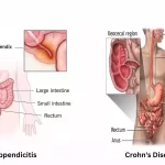 Appendicitis and Crohn's Disease