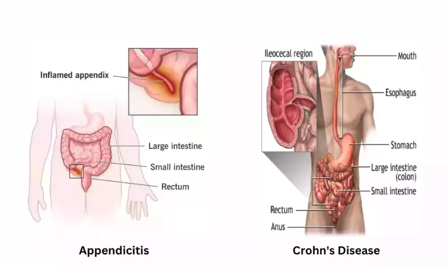 Between Appendicitis and Crohn’s Disease 18 fancy difference