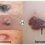 Carcinoma and Sarcoma