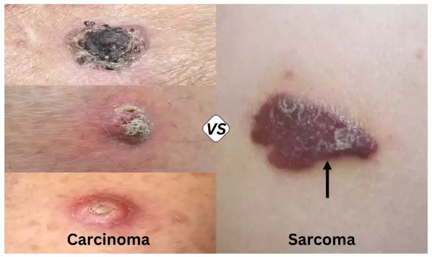 Between Carcinoma and Sarcoma the best 8 difference