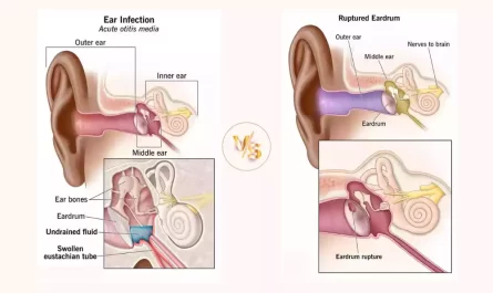 Ear Infection and Ruptured Eardrum