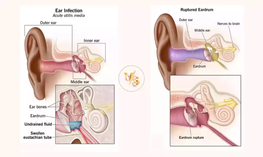 Difference Between Ear Infection and Ruptured Eardrum