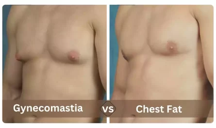 Gynecomastia and Chest Fat