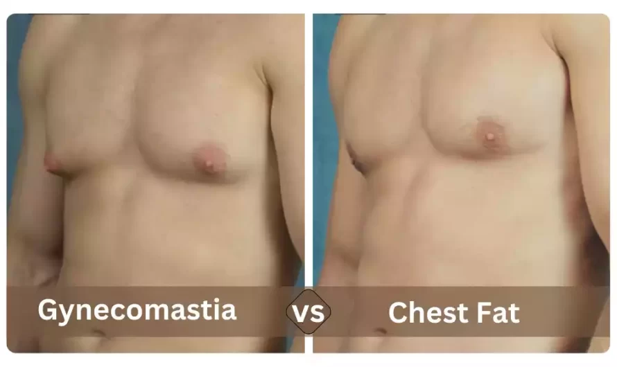 Between Gynecomastia and Chest Fat the best 8 difference