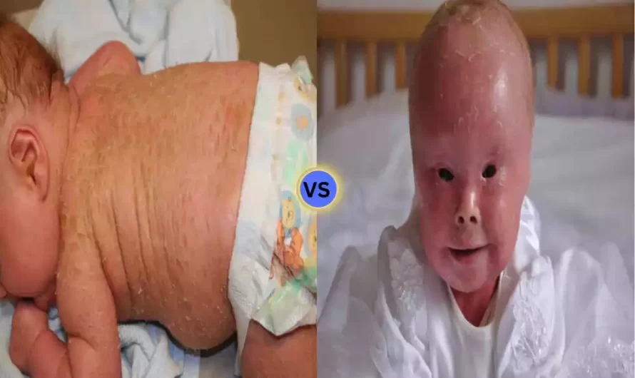 Between Lamellar Ichthyosis and Harlequin Ichthyosis best 7 difference