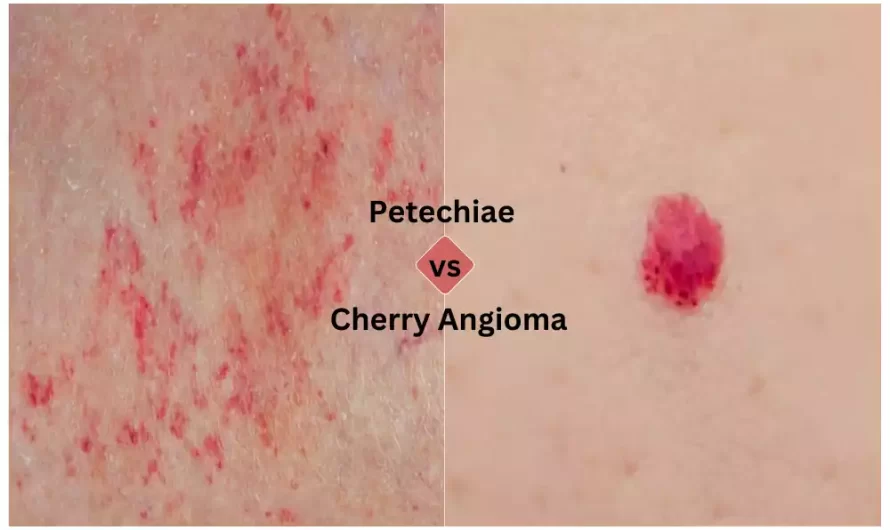 Between Petechiae and Cherry Angioma best 11 difference