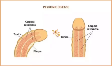 Peyronie’s and Curve