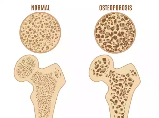 Primary Osteoporosis