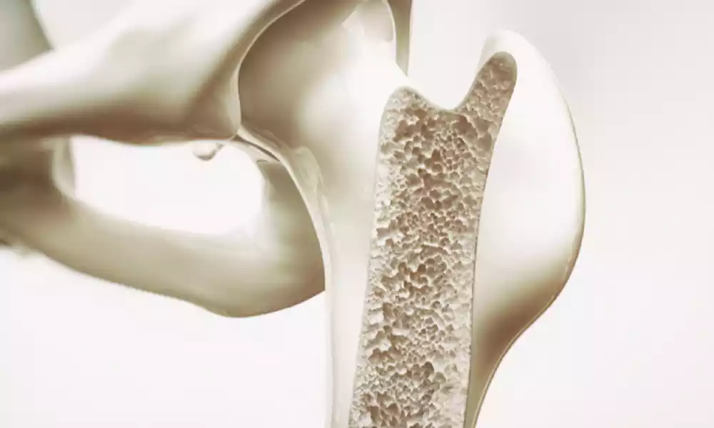Primary and Secondary Osteoporosis