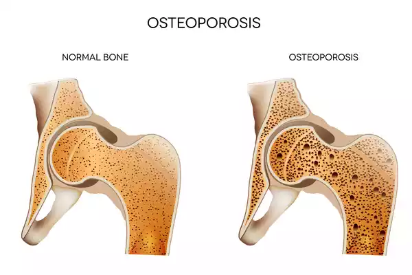 Secondary Osteoporosis