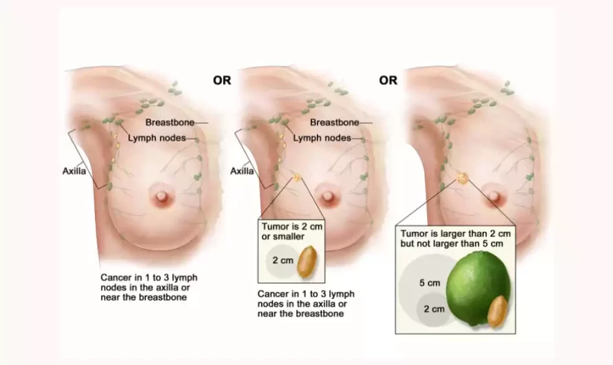 Between Stage 2 and Stage 3 Breast Cancer the top 14 difference
