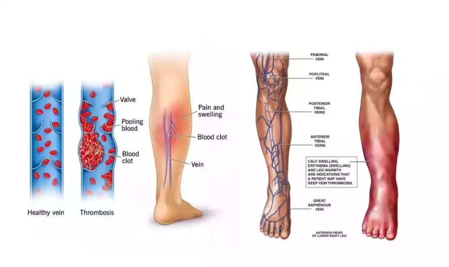 Between Thrombophlebitis and Phlebothrombosis the best 8 difference