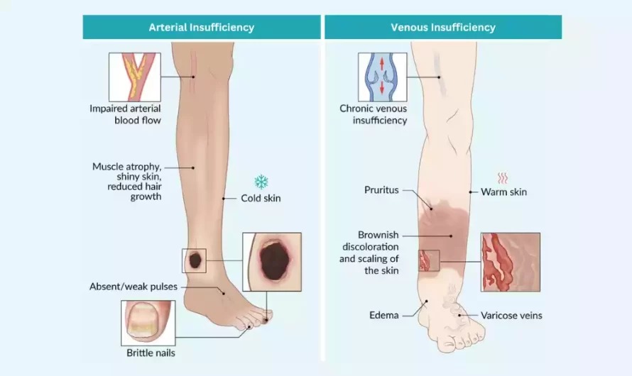 Between Venous and Arterial Insufficiency unique and best difference