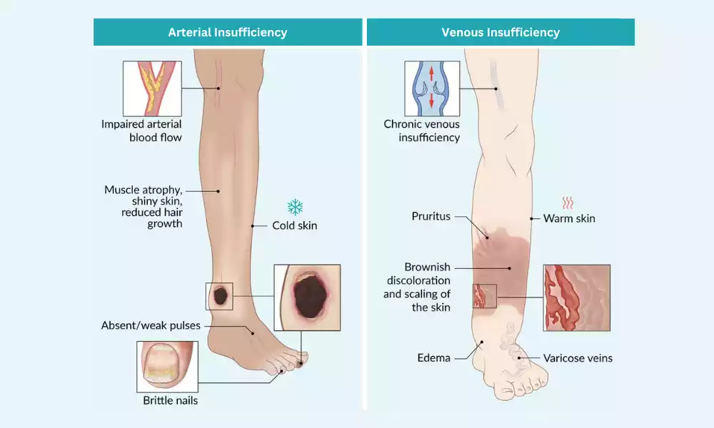 Venous and Arterial Insufficiency