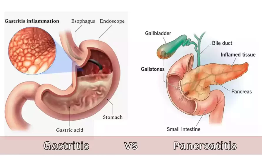 Gastritis and Pancreatitis the top 8 difference