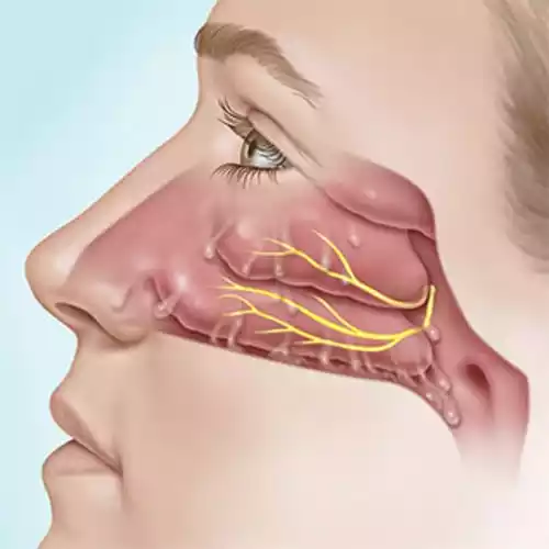 Allergic Rhinitis