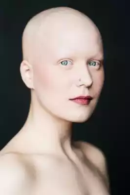 Alopecia Universalis