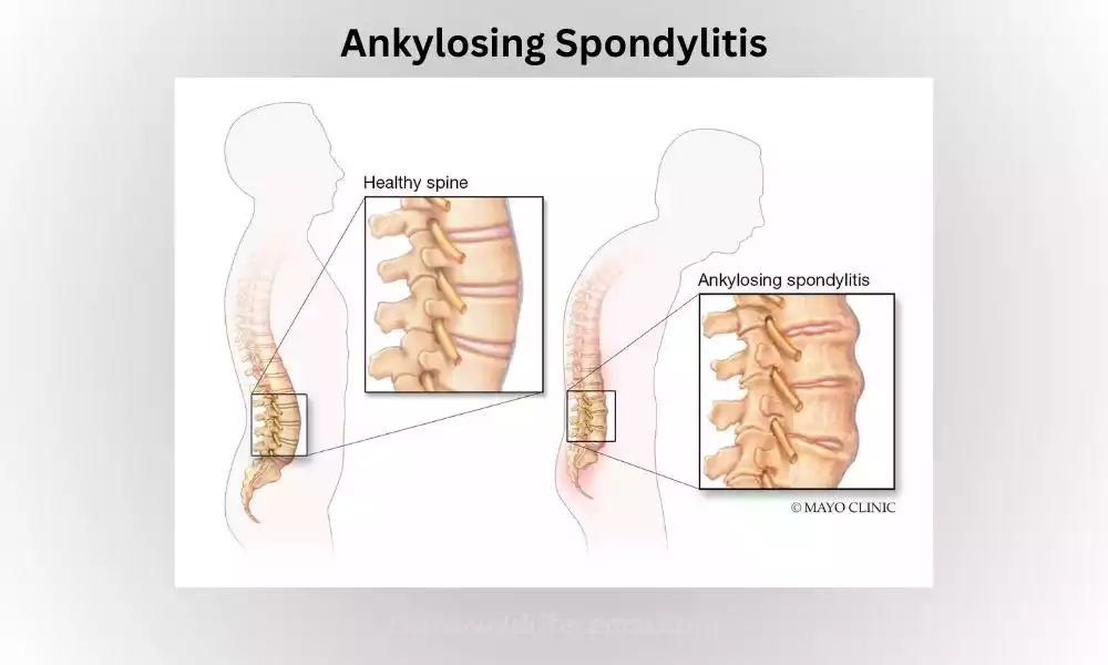 Ankylosing Spondylitis