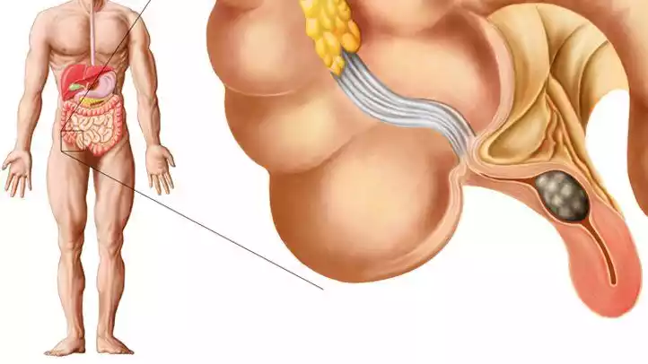 Appendicitis Causes