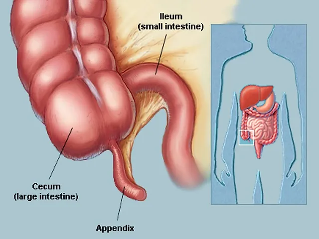 Appendicitis