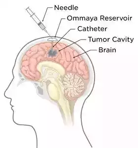 Astrocytoma