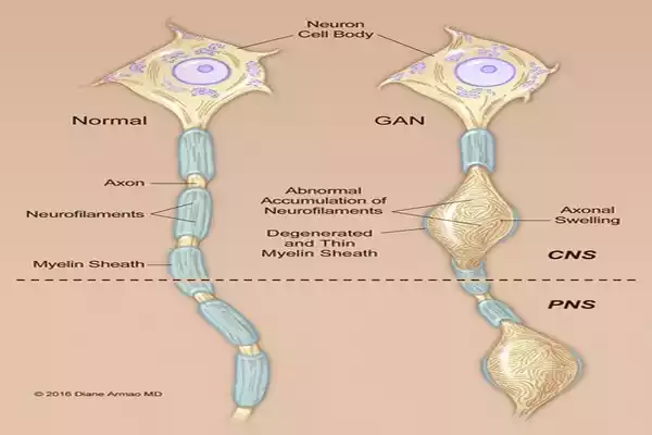 Axonal Neuropathy