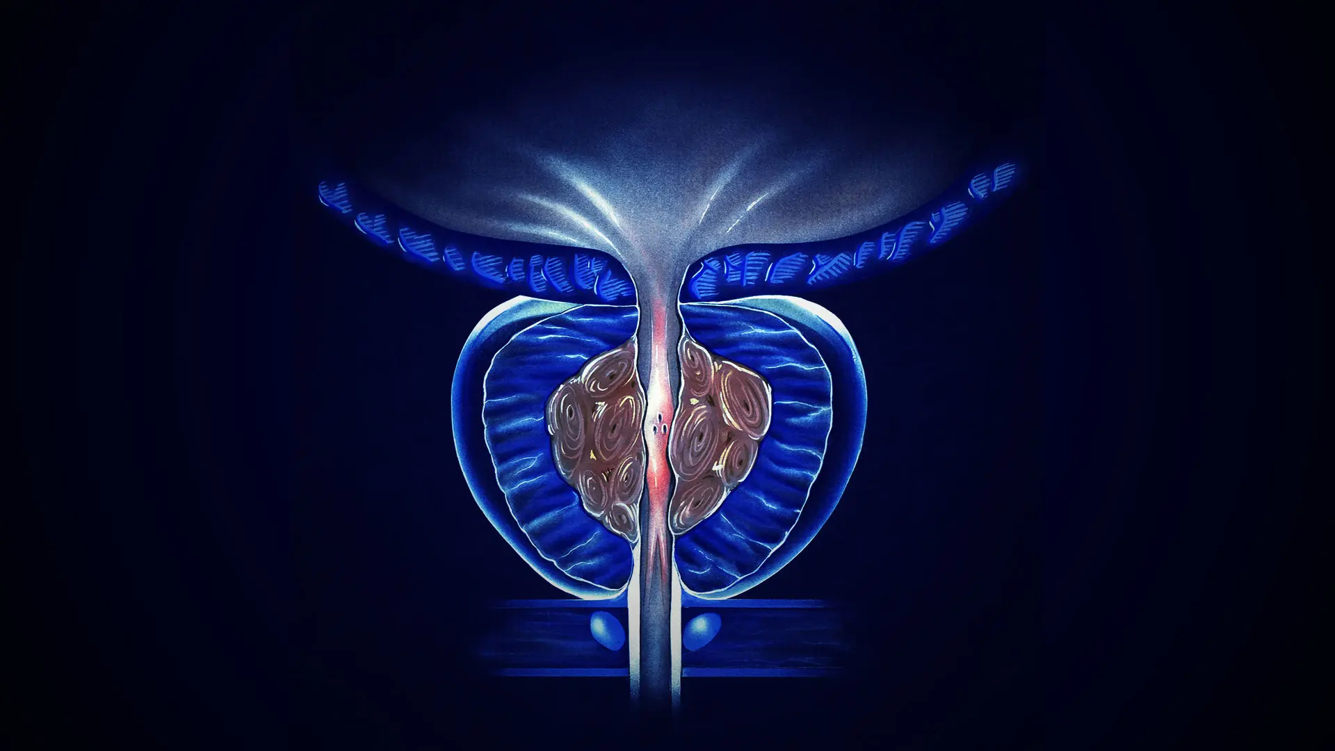 Difference Between BPH and Prostatitis