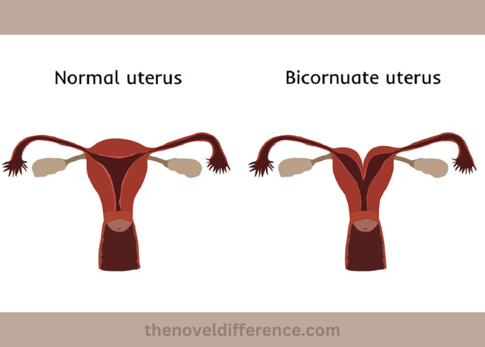 Bicornuate Uterus